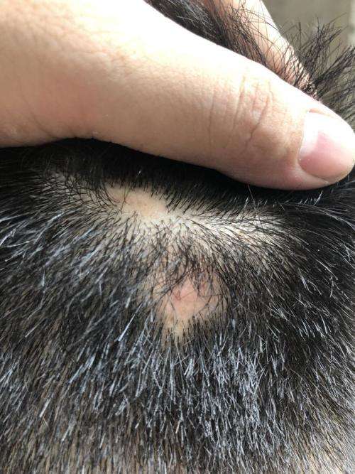 后脑勺有个凸起的软包 后脑勺有个凸起的软包图片