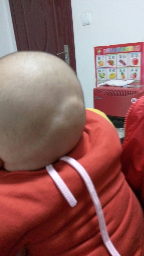 后脑勺有个凸起的软包 后脑勺有个凸起的软包图片