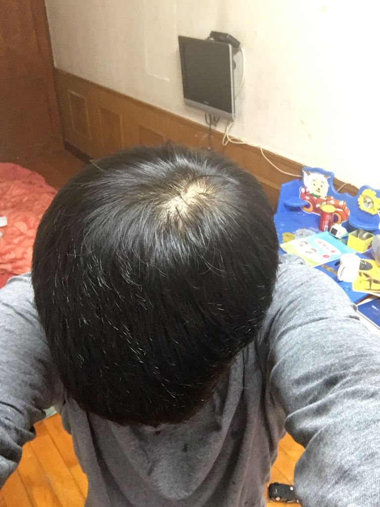 秃顶怎么办 头发可以种植吗?如果是秃顶怎么办