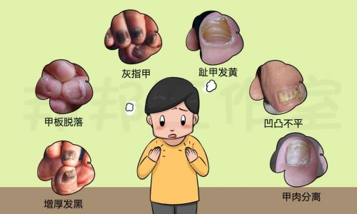 灰指甲怎么办 脚上有灰指甲怎么办