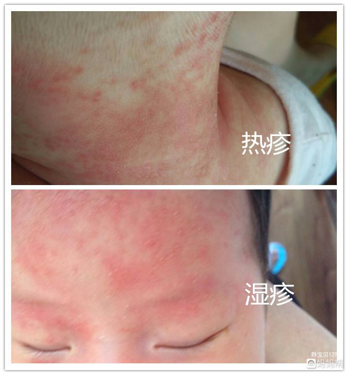产妇热疹(产妇热疹能吃鱼吗)